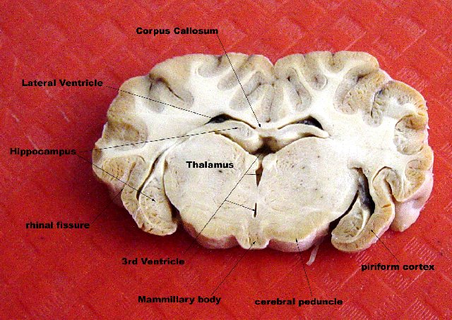 Coronal through Mammillary body